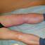 29. Thrombosis Symptoms Leg Pictures