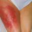 32. Thrombosis Symptoms Leg Pictures