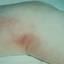 4. Thrombosis Symptoms Leg Pictures