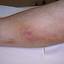 6. Thrombosis Symptoms Leg Pictures