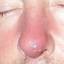 1. Nose Boil Pictures