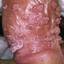 1. Papilloma in Men Pictures