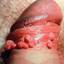 110. Papilloma in Men Pictures