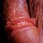 19. Papilloma in Men Pictures