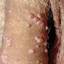 2. Papilloma in Men Pictures