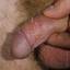 25. Papilloma in Men Pictures