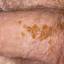 28. Papilloma in Men Pictures