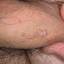 36. Papilloma in Men Pictures