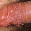 38. Papilloma in Men Pictures