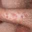 40. Papilloma in Men Pictures
