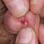 41. Papilloma in Men Pictures