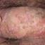 45. Papilloma in Men Pictures