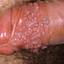 47. Papilloma in Men Pictures