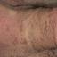7. Papilloma in Men Pictures