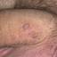 71. Papilloma in Men Pictures
