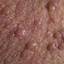72. Papilloma in Men Pictures