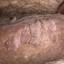 74. Papilloma in Men Pictures
