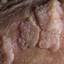 75. Papilloma in Men Pictures
