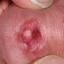 83. Papilloma in Men Pictures
