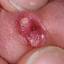 84. Papilloma in Men Pictures