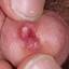 85. Papilloma in Men Pictures