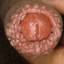86. Papilloma in Men Pictures
