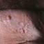 87. Papilloma in Men Pictures