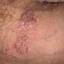 9. Papilloma in Men Pictures