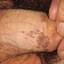 91. Papilloma in Men Pictures