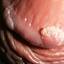 11. Papilloma on the penis Pictures