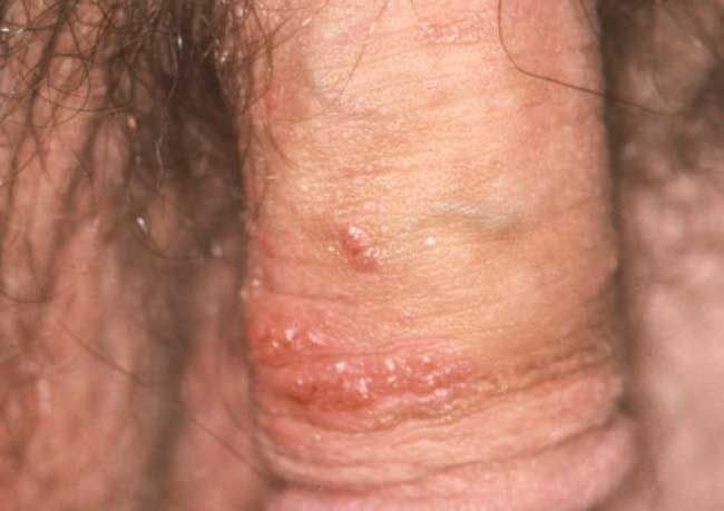 Cervical Cancer, A Sequela Of A Sexually Transmitted Infection