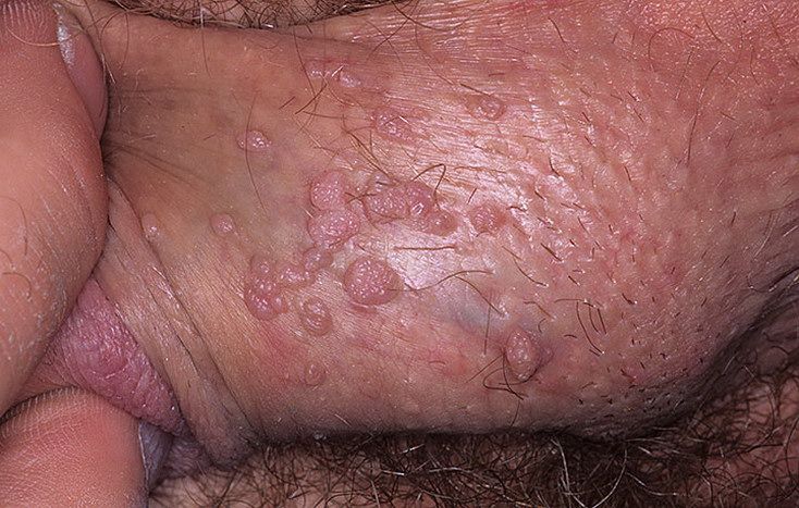 My Experience With Anal Warts