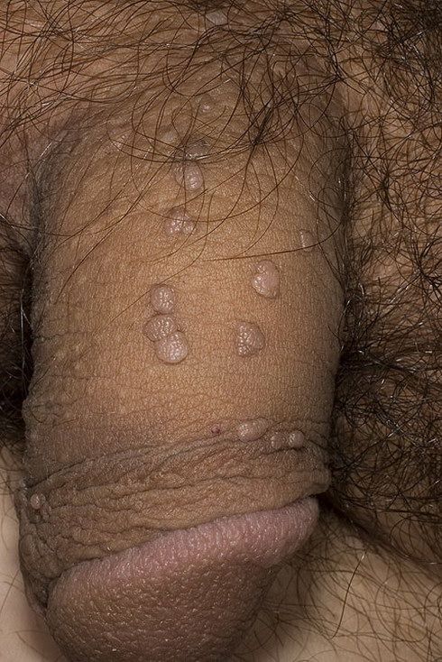 Information About Anal Warts