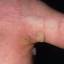 6. Papilloma on the Palms Pictures