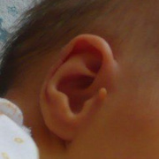 Papilloma on the Ears
