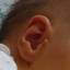 1. Papilloma on the Ears Pictures
