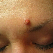 Papilloma on the Forehead