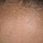 11. Papilloma on the Forehead Pictures