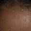 13. Papilloma on the Forehead Pictures