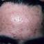 14. Papilloma on the Forehead Pictures