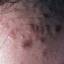 16. Papilloma on the Forehead Pictures