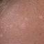 17. Papilloma on the Forehead Pictures