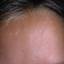18. Papilloma on the Forehead Pictures