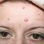 2. Papilloma on the Forehead Pictures