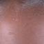 21. Papilloma on the Forehead Pictures