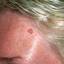 23. Papilloma on the Forehead Pictures