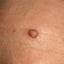 24. Papilloma on the Forehead Pictures