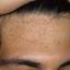 3. Papilloma on the Forehead Pictures