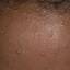 5. Papilloma on the Forehead Pictures