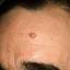 6. Papilloma on the Forehead Pictures